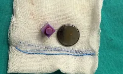 Kayseri’de minik A.Y.Ç.’nin tehlikeli yutkunması ameliyatla sonuçlandı