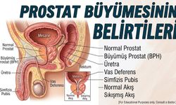 Prostat Büyümesi Belirtileri ve Tedavisi, Ameliyatsız Yöntemler